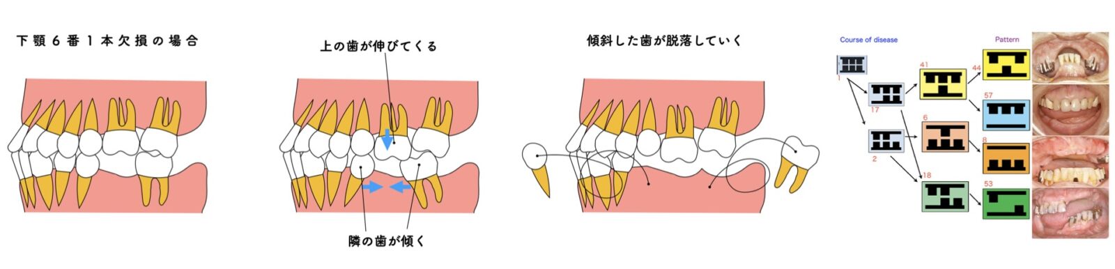 下顎6番1本欠損から歯の挺出・傾斜が進行し歯列全体が崩れていく過程の模式図