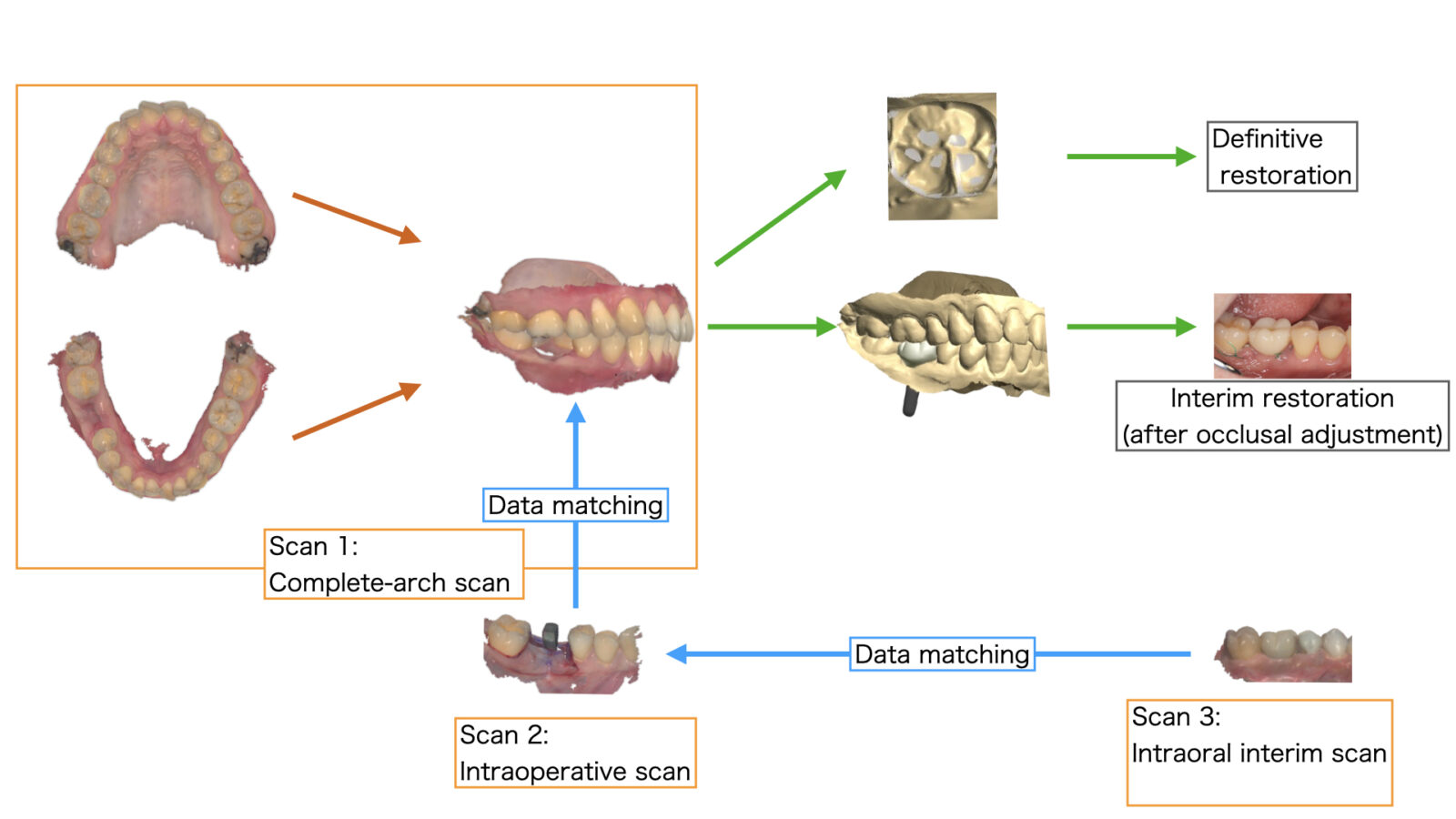 インプラント治療におけるフルアーチスキャン・術中スキャン・仮歯スキャンを統合するデジタルワークフロー