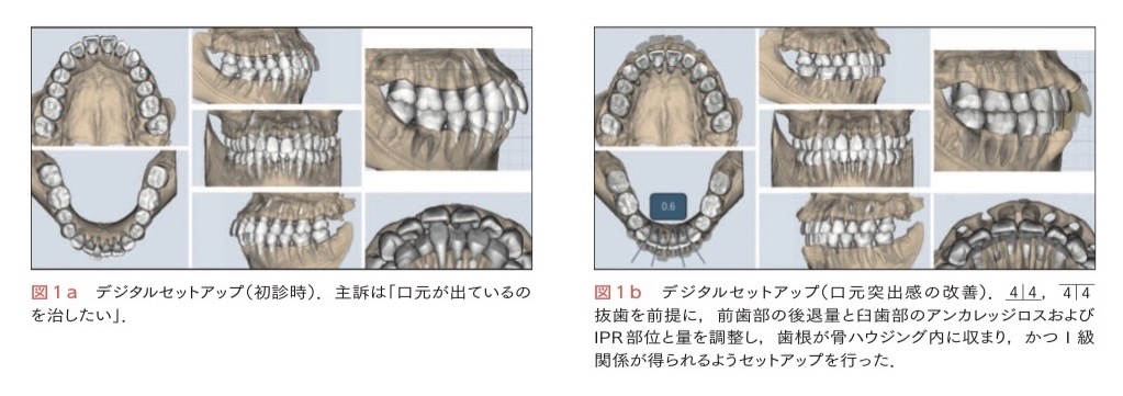 インプラント専門書に当院症例が掲載されました｜OISSに基づく矯正
