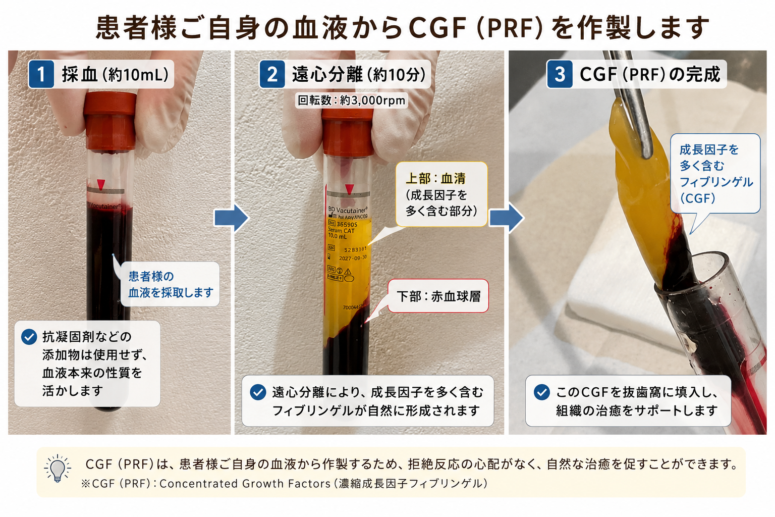 患者自身の血液を遠心分離しCGF(PRF)フィブリンゲルを作製している工程写真