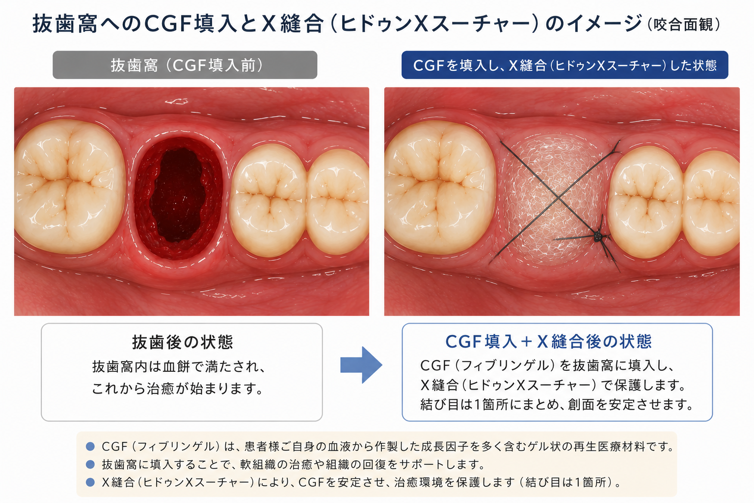CGF(PRF)を抜歯窩へ填入しX縫合で保護している模式図