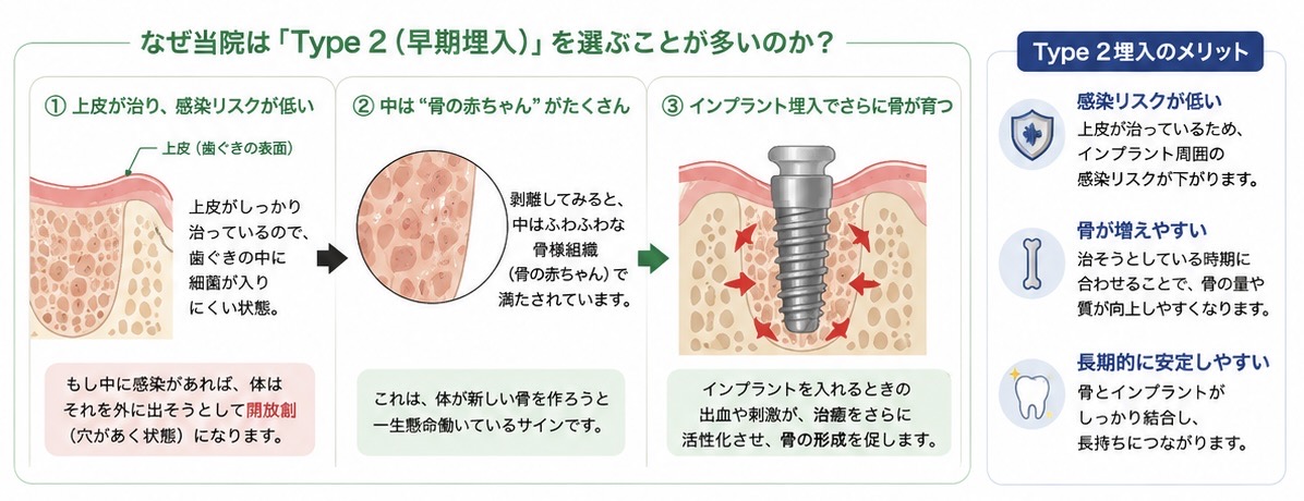 抜歯後1〜2ヶ月の状態を示す図。歯ぐきは治癒しているが内部では骨形成途中の組織が存在する状態を解説