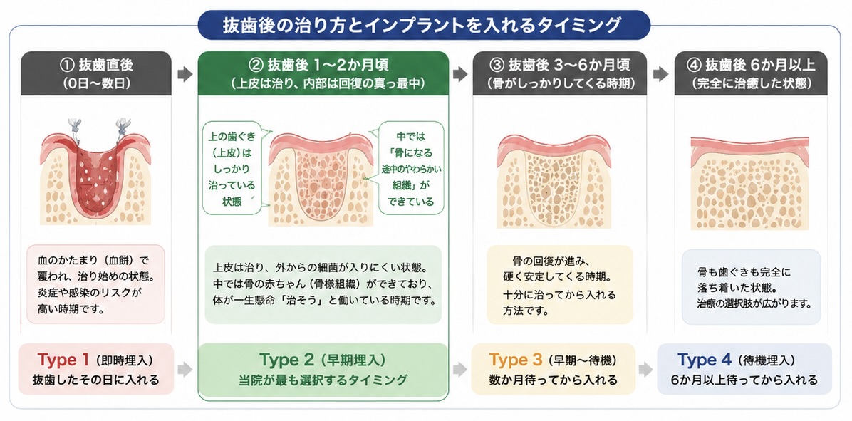 抜歯後のインプラント埋入タイミング（即時・早期・待機）と、それぞれの治癒状態の違いを示した図解