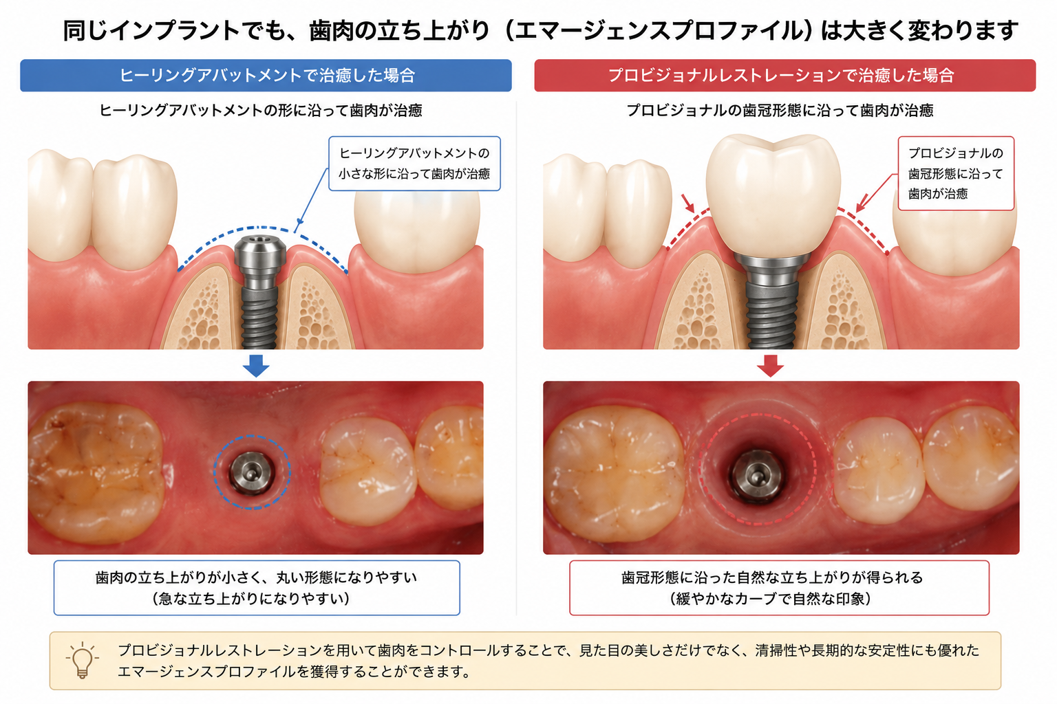 フラップレスインプラントとプロビジョナルレストレーションによるエマージェンスプロファイルの違いを解説した比較図及びインプラント治療におけるヒーリングアバットメントとプロビジョナルレストレーションによる歯肉形態形成の違い
