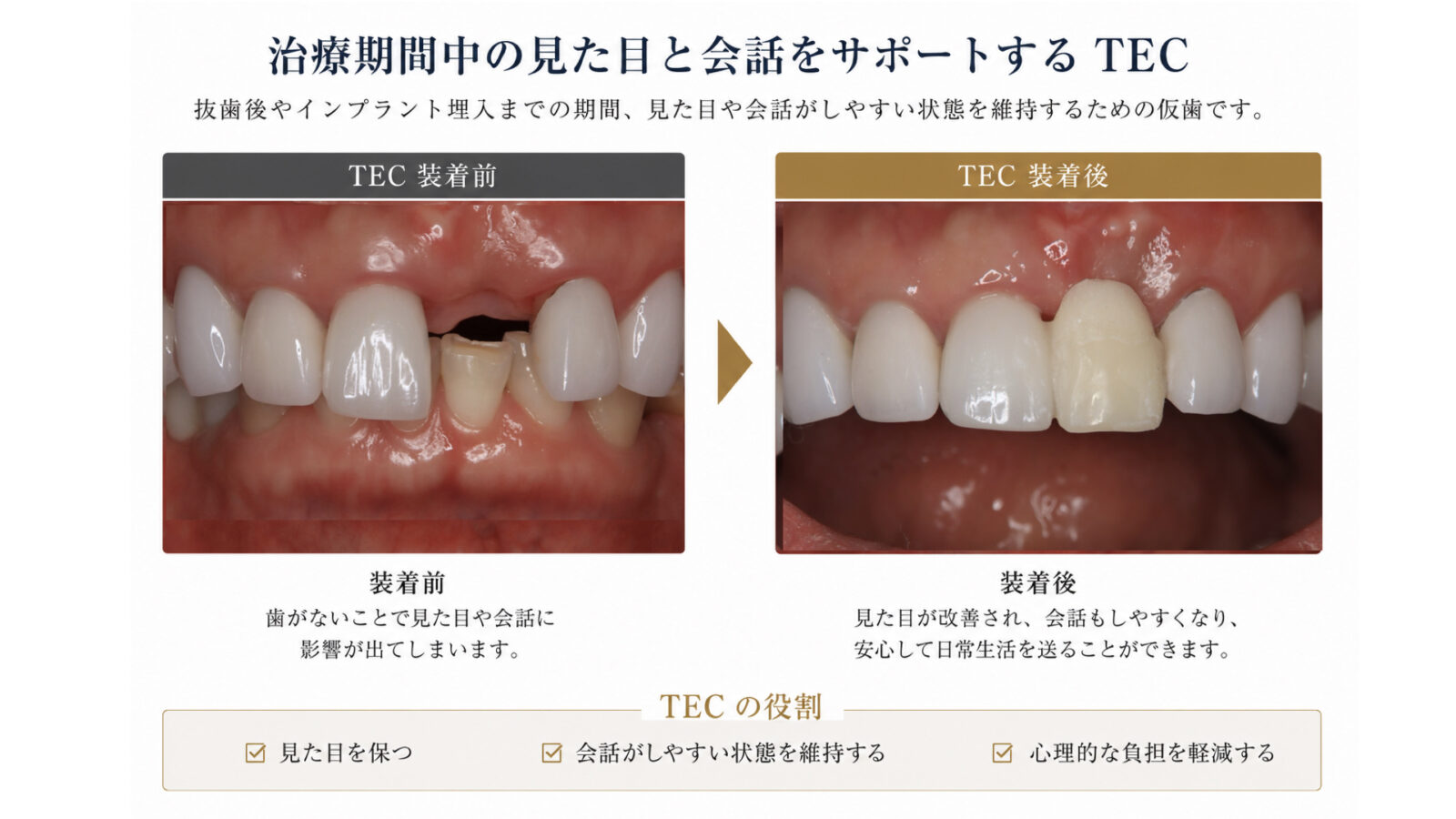 抜歯後からインプラント治療が次のステップへ進むまで使用するTEC（テンポラリークラウン）の装着前後比較