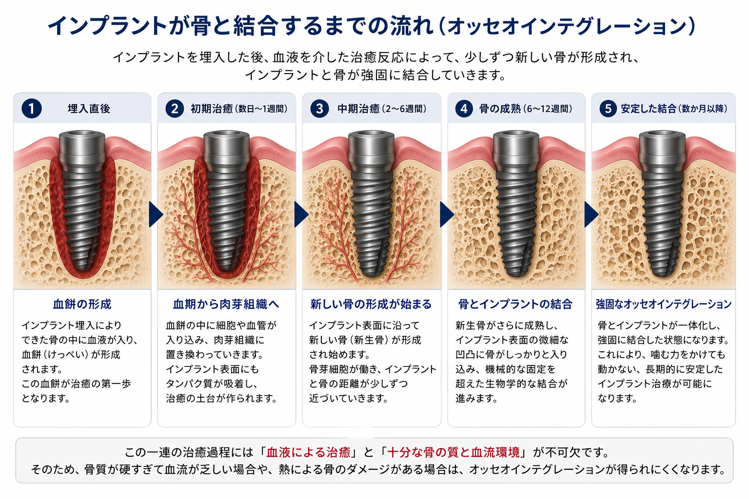 インプラント埋入後に血餅が形成され、新しい骨ができてオッセオインテグレーションが成立するまでの流れ