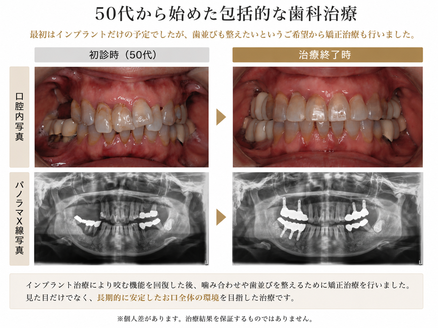 50代女性のインプラントと矯正治療の症例比較。初診時と治療後の口腔内写真・パノラマレントゲン。包括的な歯科治療による噛み合わせ改善例。