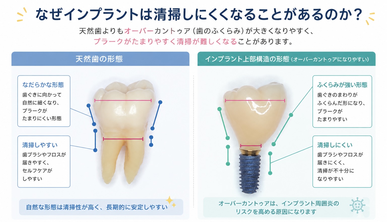 天然歯とインプラント上部構造の形態と清掃性の違いを示した比較図