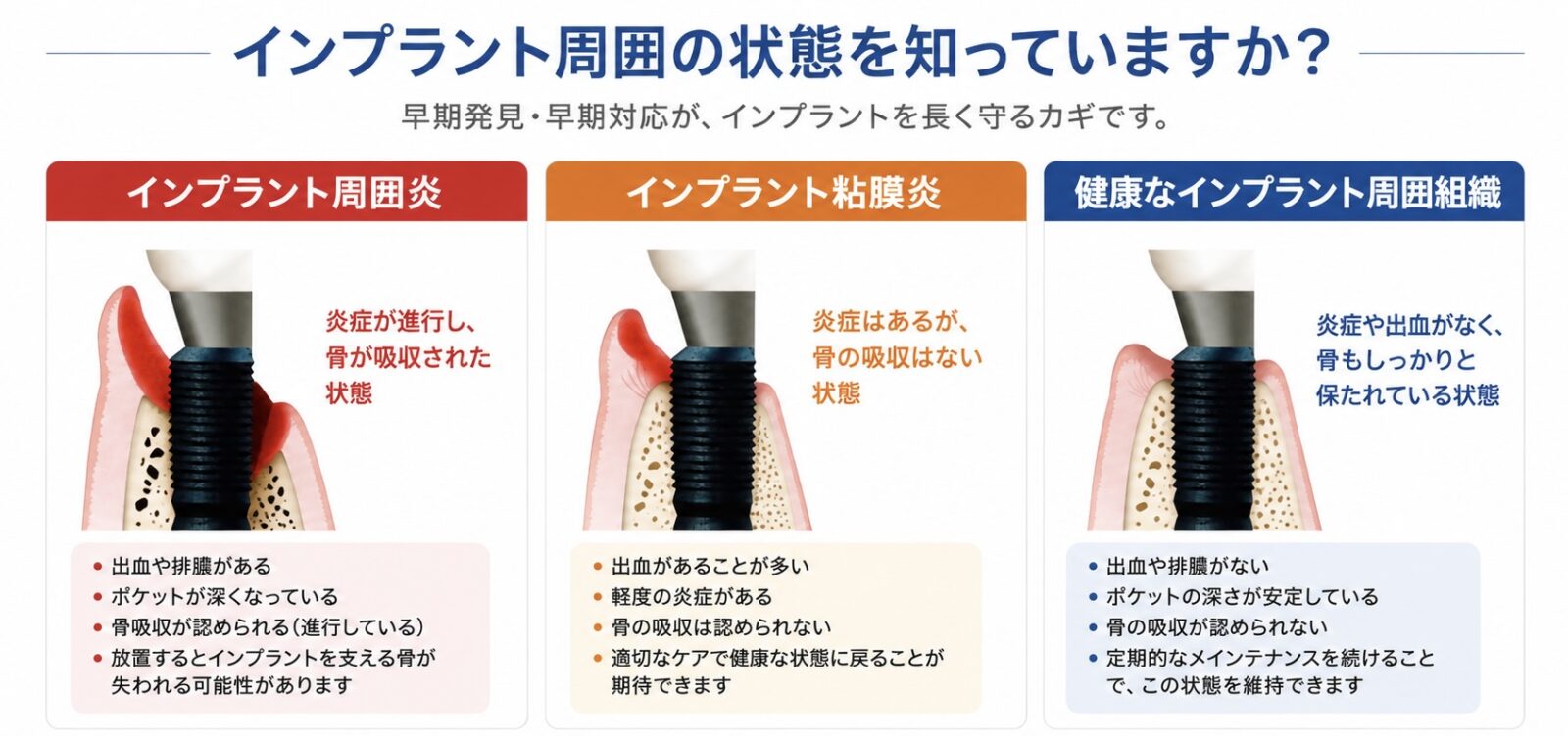 インプラント周囲炎・インプラント粘膜炎・健康なインプラント周囲組織の違いを示した比較図