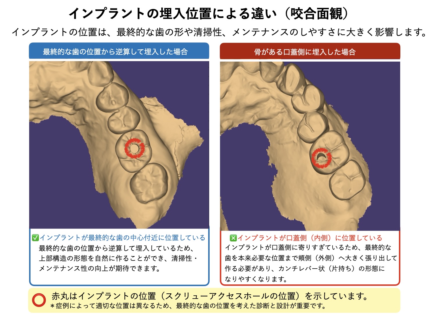 インプラントの埋入位置を咬合面から比較した画像。最終的な歯の位置から逆算した埋入と、口蓋側に寄った埋入の違いを示している。