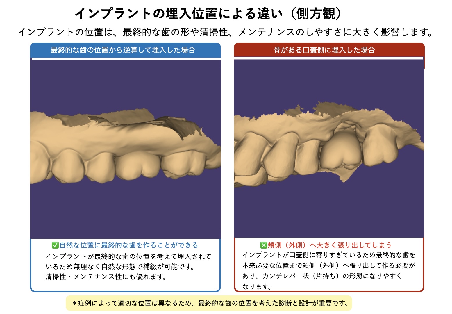 インプラントの埋入位置を側方から比較した画像。口蓋側に寄った埋入では、最終的な歯が頬側へ張り出した形態になることを示している。