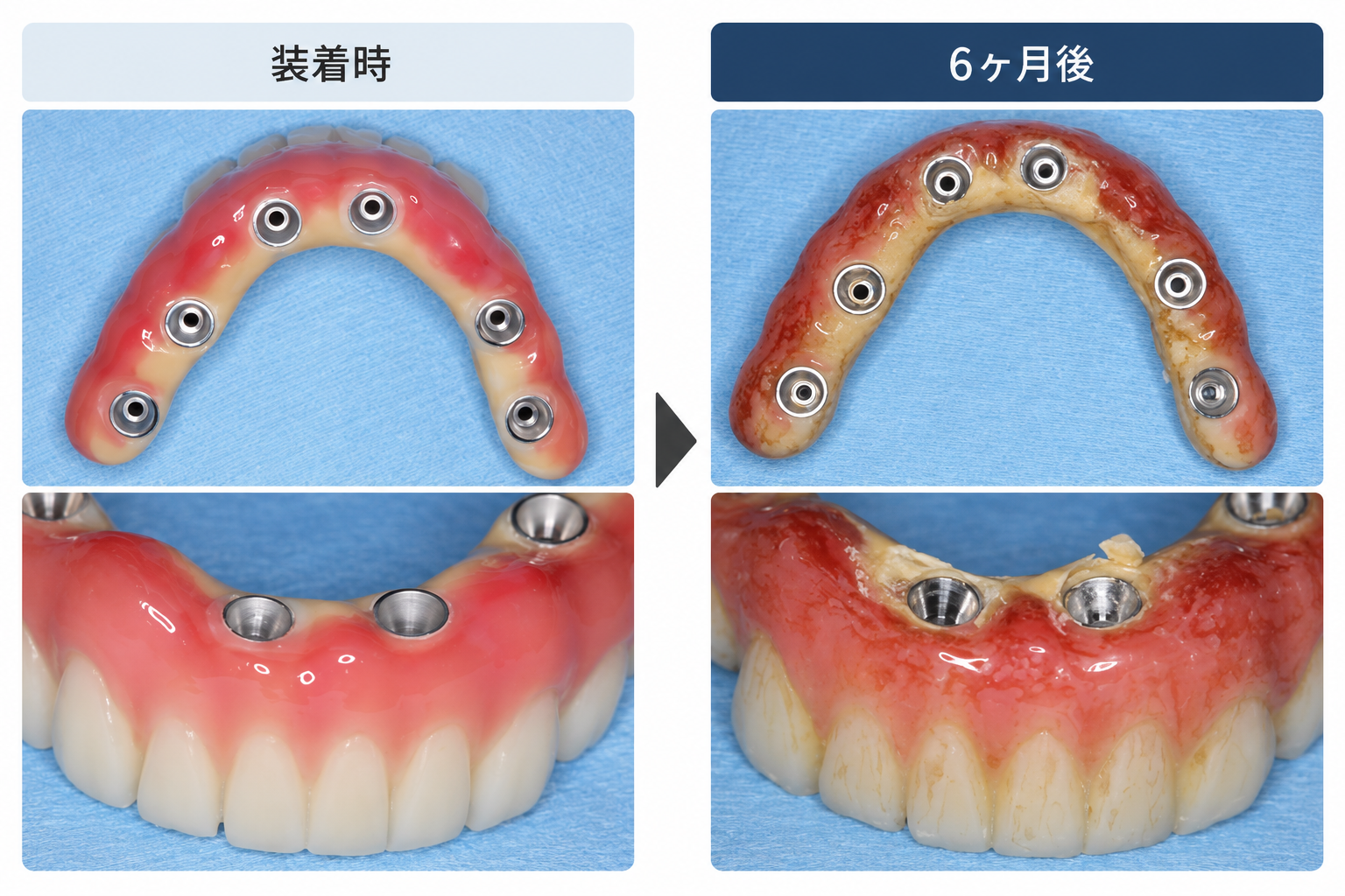大型インプラント上部構造の装着時と6か月後の粘膜面を比較した写真