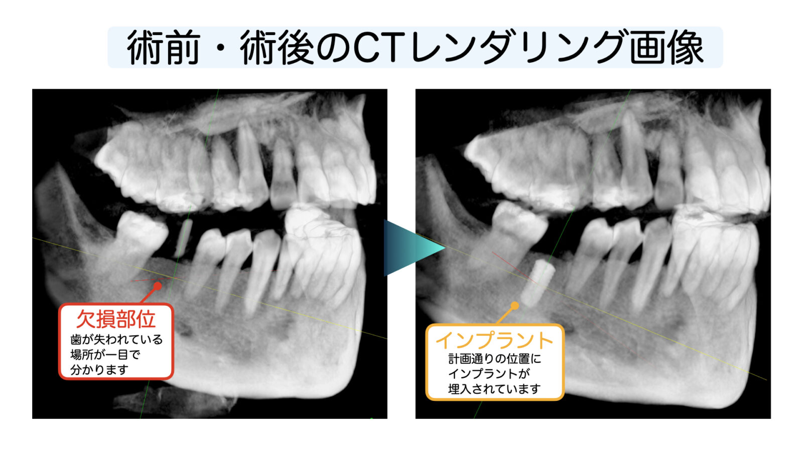 インプラント埋入前後のCTレンダリング画像｜欠損部とインプラントの位置を立体的に比較