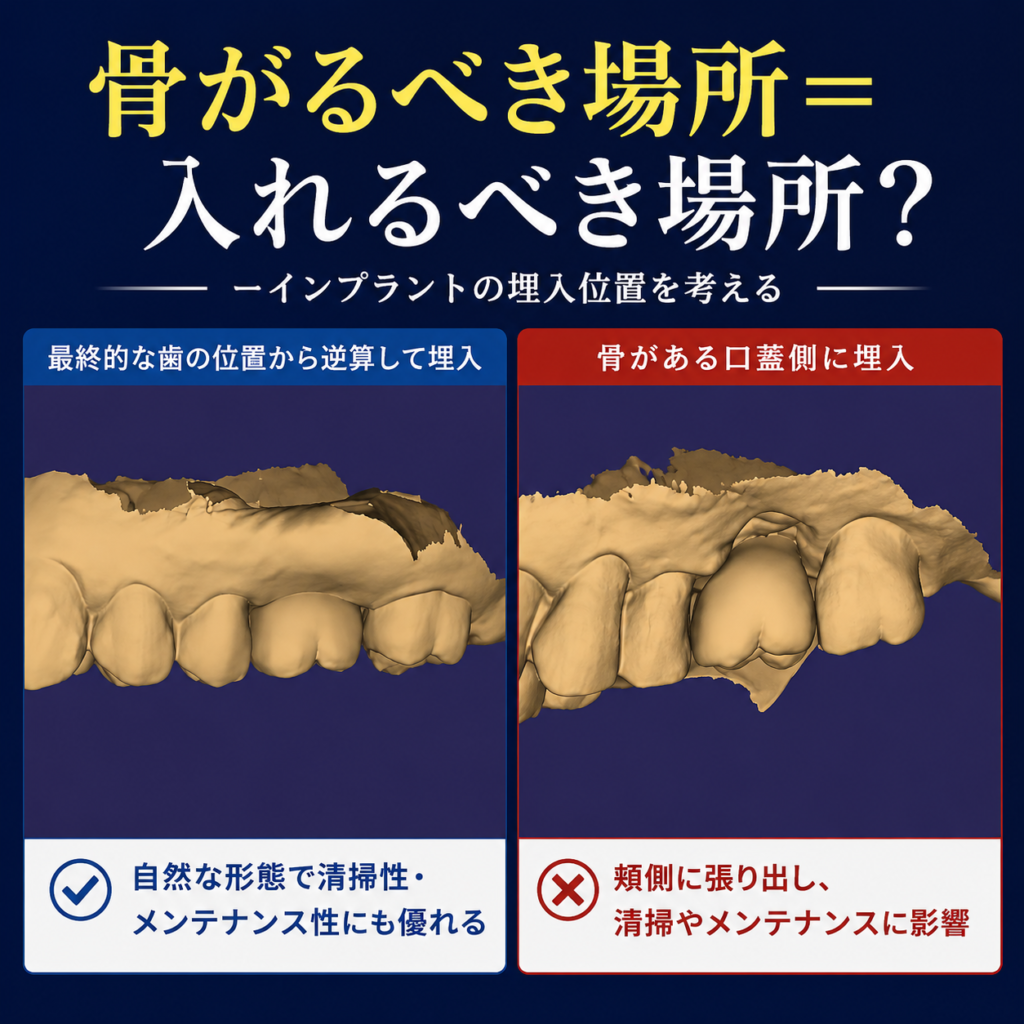 インプラントの埋入位置による最終的な歯の形の違いを比較した画像。最終的な歯から逆算した埋入と、骨のある口蓋側への埋入を比較。